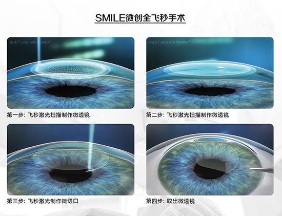 蔡司全飞秒、蔡司半飞秒近视手术与宇航飞秒的区别